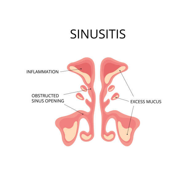 sinusitis in New Jersey