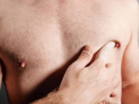 male breast reduction