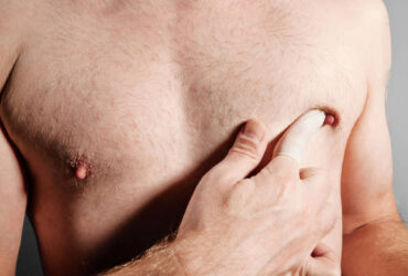 male breast reduction