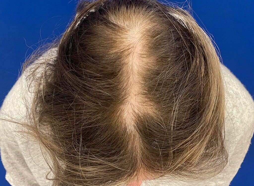 Hair transplant for women