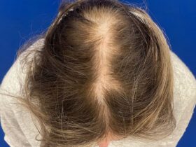 Hair transplant for women