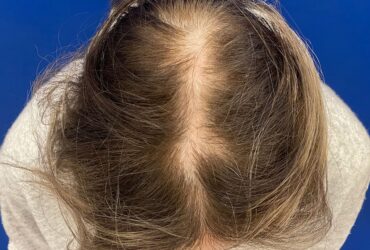 Hair transplant for women